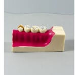 Right Lower Jaw Tooth Anatomy Sectional Model - Mandibular Molar Cross-Section with Restorations for Patient Education & Teaching - Image 3