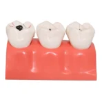 4 Times Enlarged Dental Caries Evolution Model with Detachable Teeth - Tooth Decay Progression Demonstration for Patient Education & Teaching - Image 2