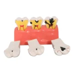 4 Times Enlarged Dental Caries Evolution Model with Detachable Teeth - Tooth Decay Progression Demonstration for Patient Education & Teaching