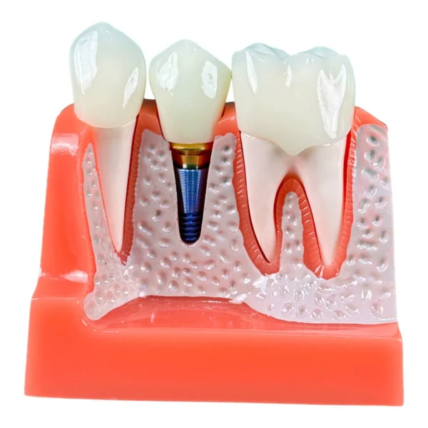 4 Times Magnified Dental Implant Demonstration Model – Perfect for Patient Education and Professional Teaching