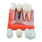 4 Times Enlarged Dental Implant Model with Removable Crown Bridge - Demonstration for Patient Education & Teaching - Image 3
