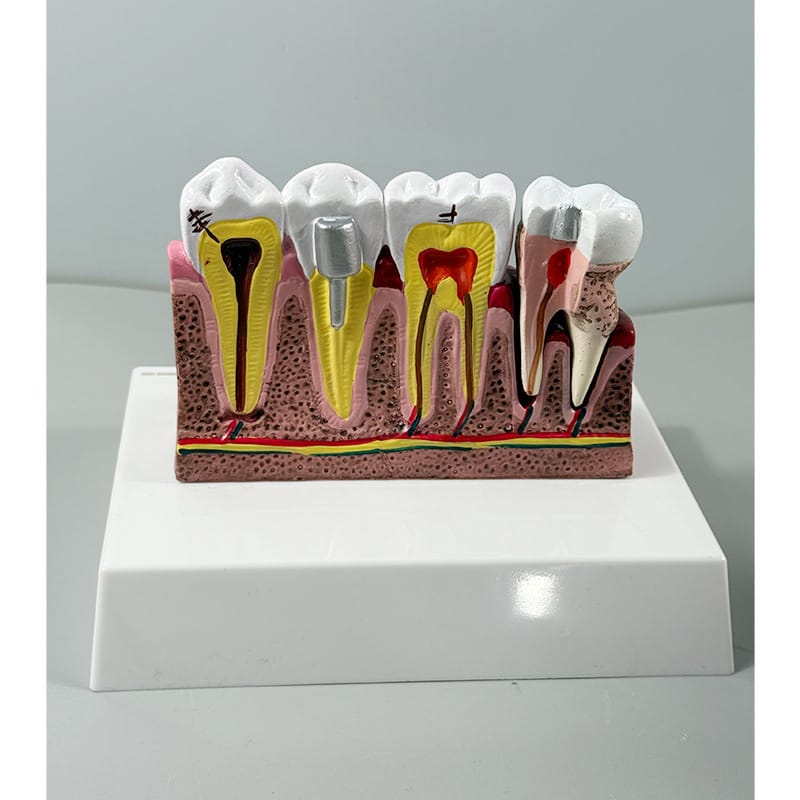 Tooth Anatomy Model with Nerve Distribution - Dental Pulp & Nerve Highlighted Cross-Section for Patient Education & Teaching