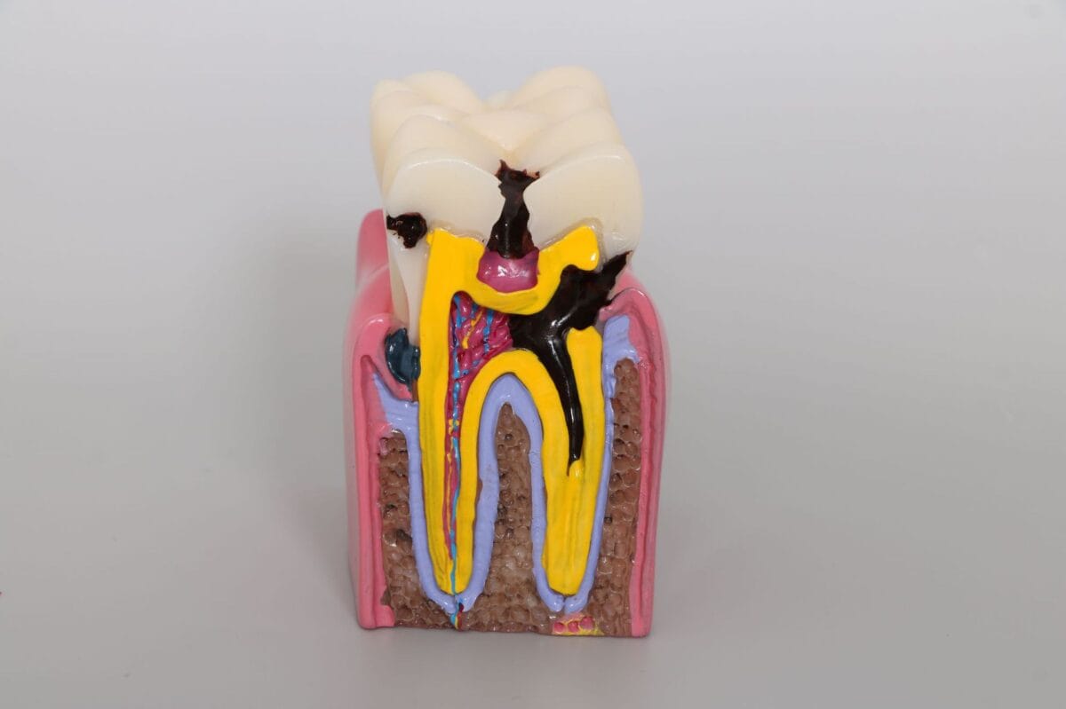 6 Times Enlarged Dental Caries Comparison Model - Magnified Tooth Decay Bilateral Cross-Section for Patient Education & Teaching - Image 2