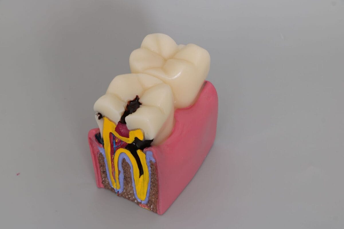 6 Times Enlarged Dental Caries Comparison Model - Magnified Tooth Decay Bilateral Cross-Section for Patient Education & Teaching