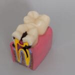 6 Times Enlarged Dental Caries Comparison Model - Magnified Tooth Decay Bilateral Cross-Section for Patient Education & Teaching