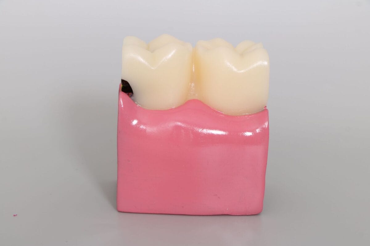 6 Times Enlarged Dental Caries Comparison Model - Magnified Tooth Decay Bilateral Cross-Section for Patient Education & Teaching - Image 3