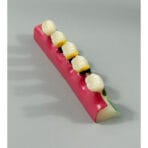 Periodontal Disease Progression Model - 5 Stages: Normal, Gingivitis, Early/Moderate/Advanced Periodontitis & Occlusal Trauma for Patient Education - Image 3