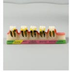 Periodontal Disease Progression Model - 5 Stages: Normal, Gingivitis, Early/Moderate/Advanced Periodontitis & Occlusal Trauma for Patient Education - Image 2