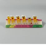 Dental Caries Progression Model - 5 Stages: Normal, Shallow, Moderate, Advanced, Residual Root with Succedaneous Teeth for Patient Education