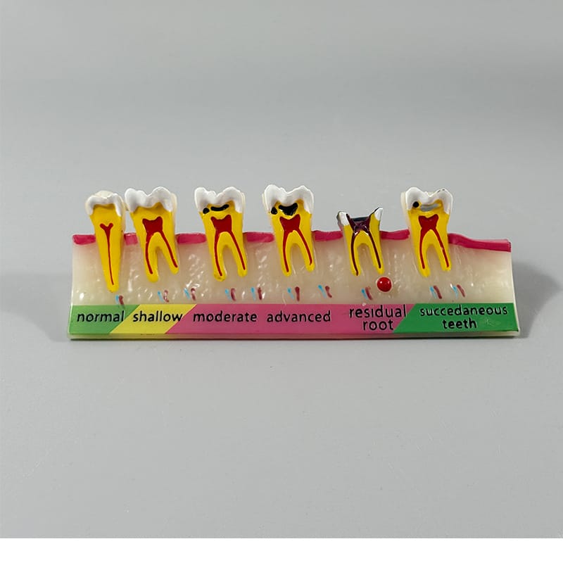 Dental Caries Progression Model - 5 Stages: Normal, Shallow, Moderate, Advanced, Residual Root with Succedaneous Teeth for Patient Education