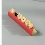 Dental Caries Progression Model - 5 Stages: Normal, Shallow, Moderate, Advanced, Residual Root with Succedaneous Teeth for Patient Education - Image 5