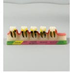 Periodontal Disease Progression Model – 5 Stages for Effective Patient Education & Dental Teaching